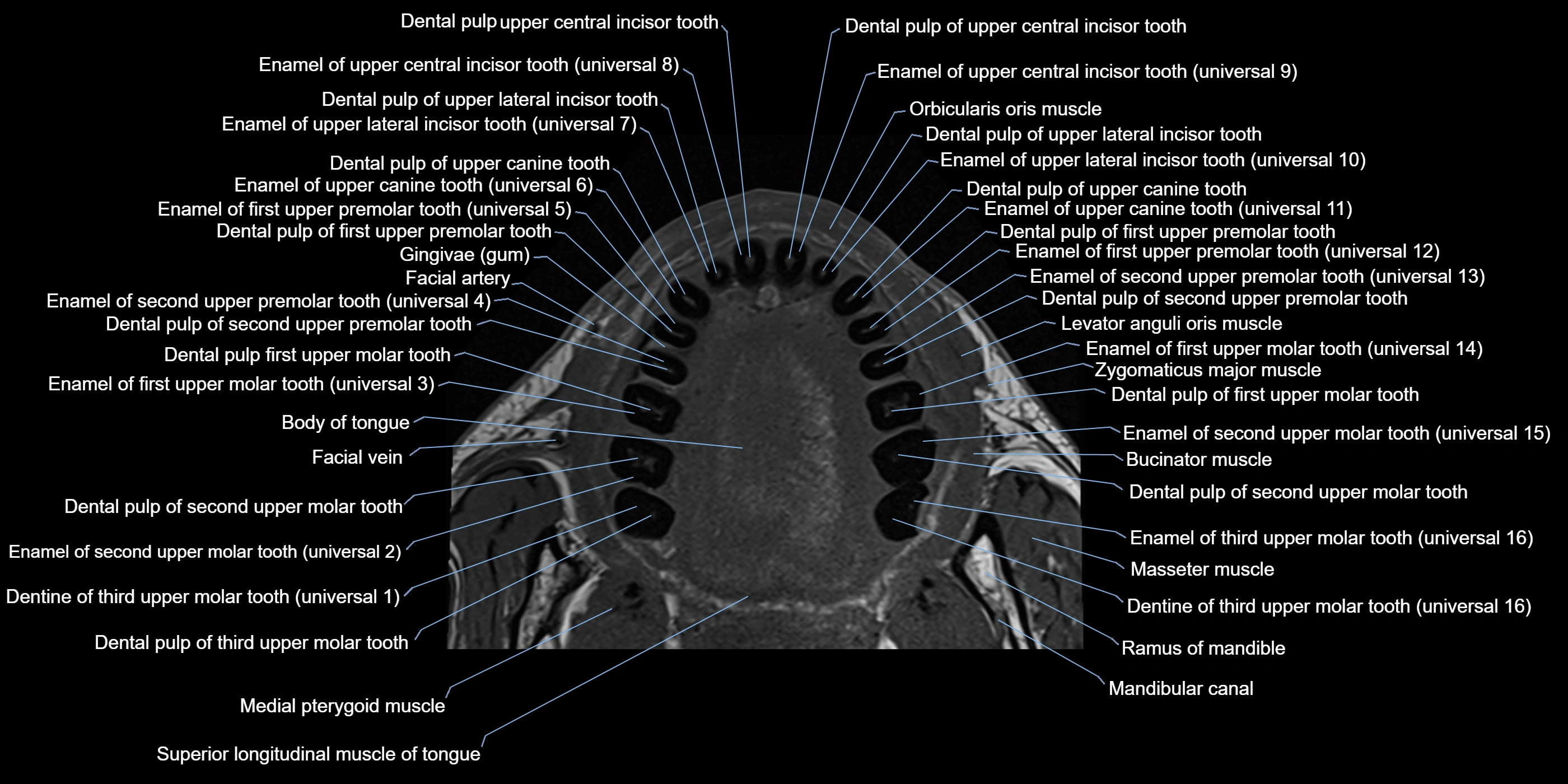 Dental MRI( tooth) axial labelled  cross sectional 3T anatomy -img-00006.webp